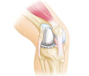Partial Knee Replacement Partial Knee Replacement