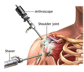 Shoulder & knee Arthroscopy Shoulder & knee Arthroscopy