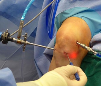 Key Hole Surgery Key Hole Surgery